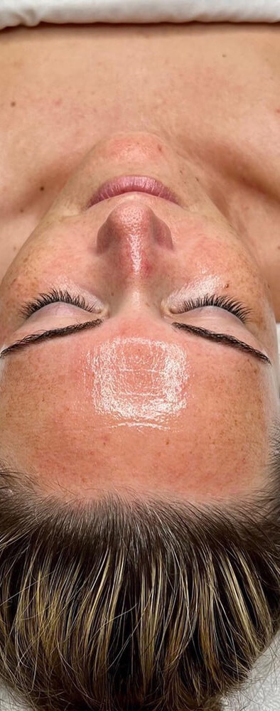 Nach der AquaFacial-Behandlung bei Beauty by Gashi Grenchen
