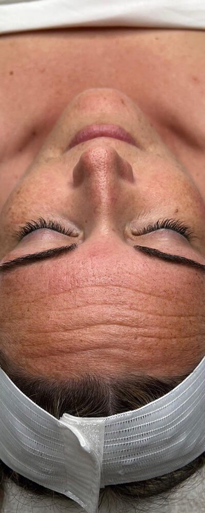 Vor der AquaFacial-Behandlung bei Beauty by Gashi Grenchen