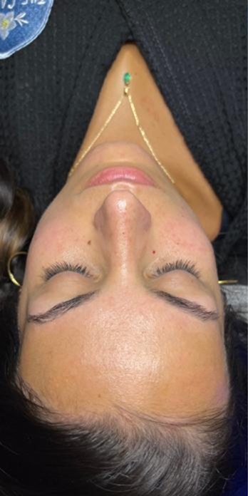 Teint vor der AquaFacial-Behandlung bei Beauty by Gashi